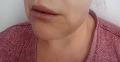 negligencia dental abogado clinica concepcion